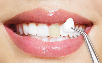 10 Lucruri neștiute despre fațetele dentare